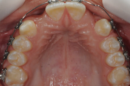 Ausência Dentária (Agenesia)