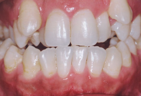 Classe 1 - Apinhamento Dentário